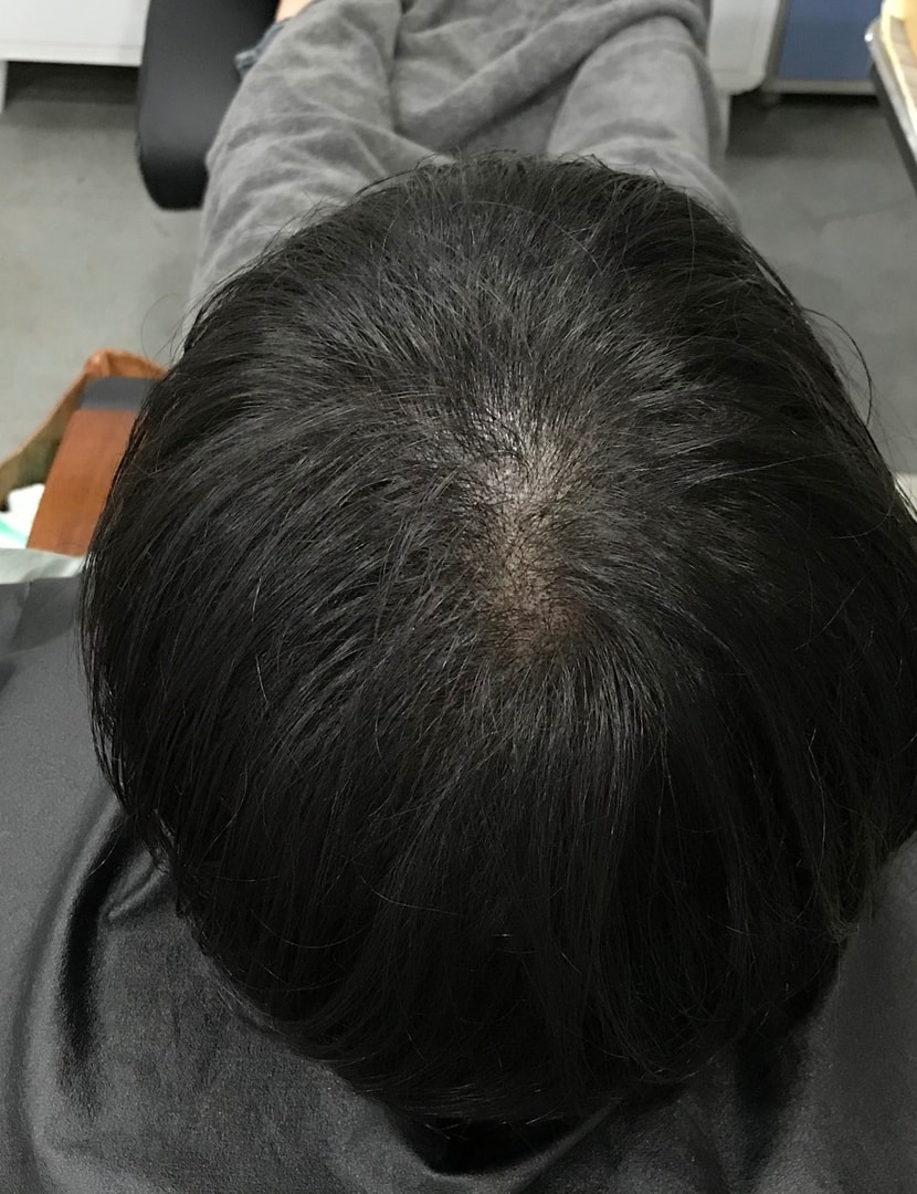 첫 시술 이후