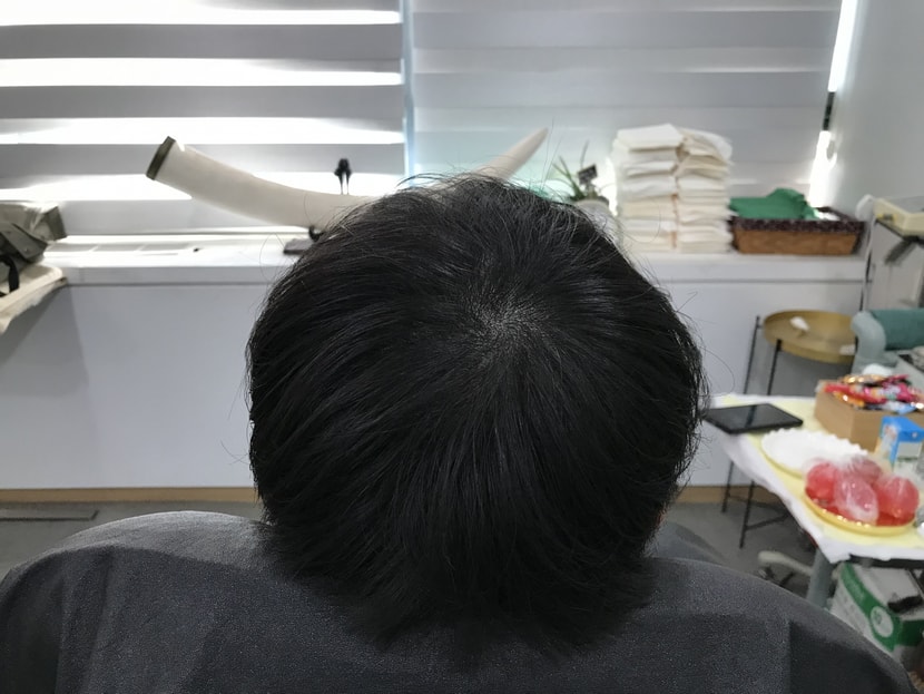2년간 3~4번 리터치 및 꾸준한 약 복용 결과