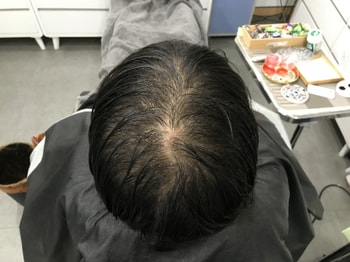 첫 시술 전