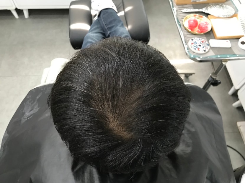 시술전 머리(내머리 정수리가 맞군요 휑~)