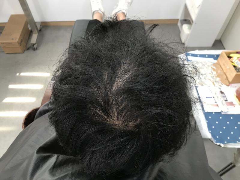 頭頂頭皮タトゥー後記