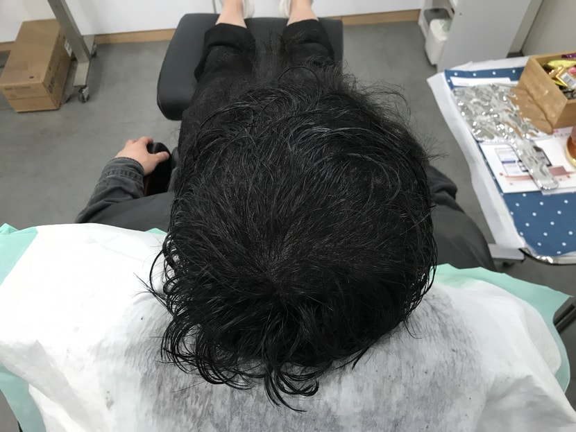 시술후 젖은 머리