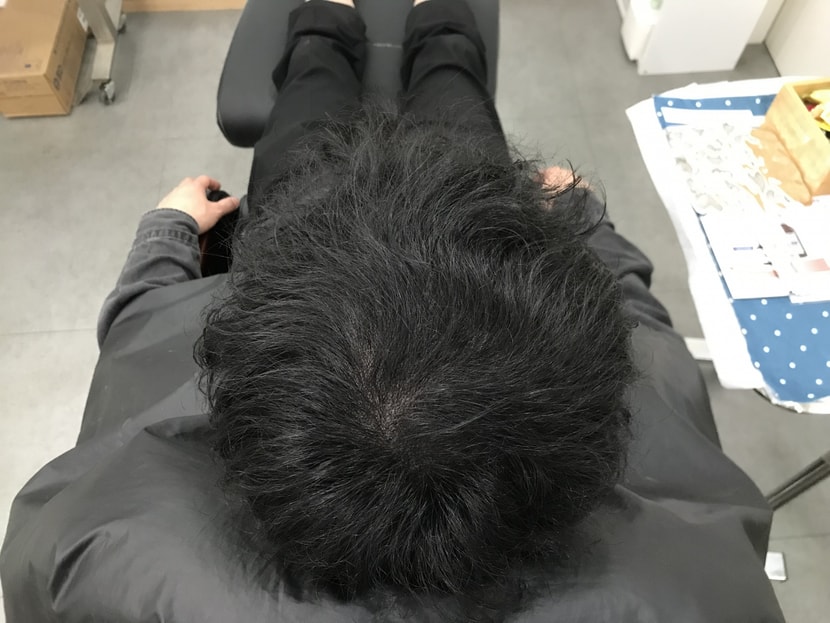 시술후 마른 머리
