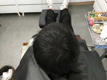 두피문신후