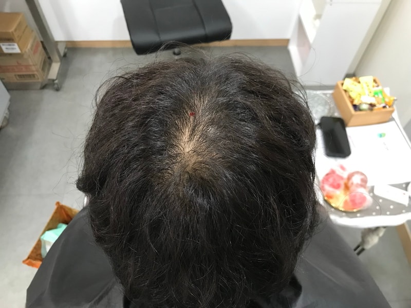 头皮纹身