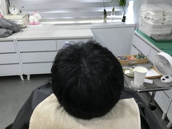 시술후