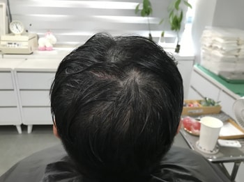 시술전