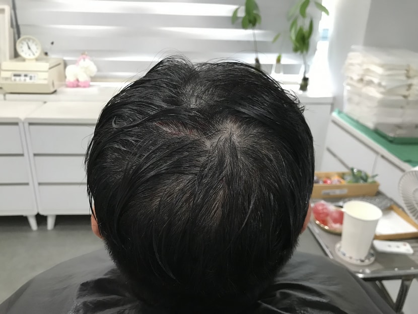 시술전
