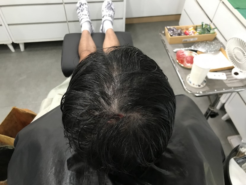 시술전