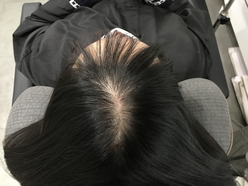 시술전
