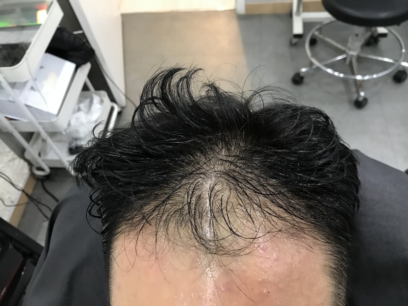 연세미다인 상담 + 두피문신