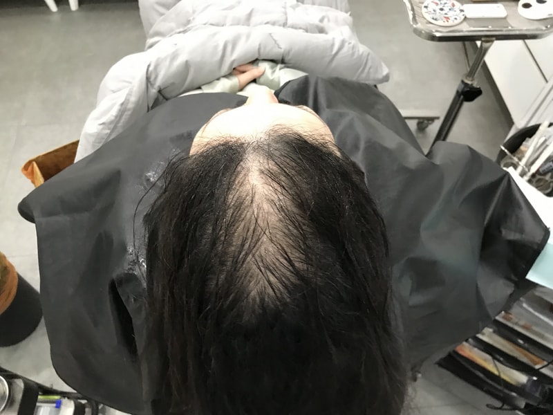 延世ミダイン グラデーション ドット 頭皮 刺青 1次 体験談