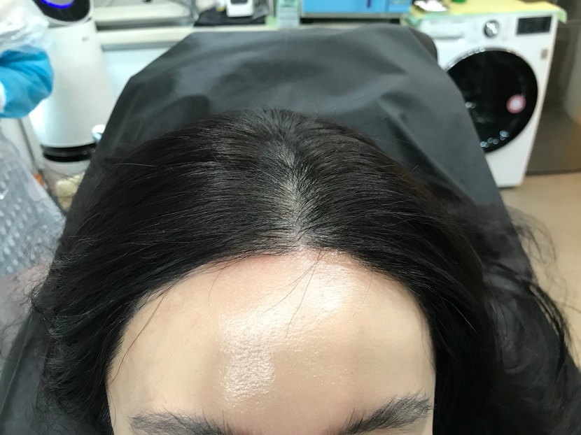 2차 리터치 두피문신 전
