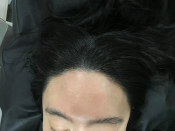 2차 리터치 두피문신 후