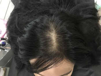 1차시술전