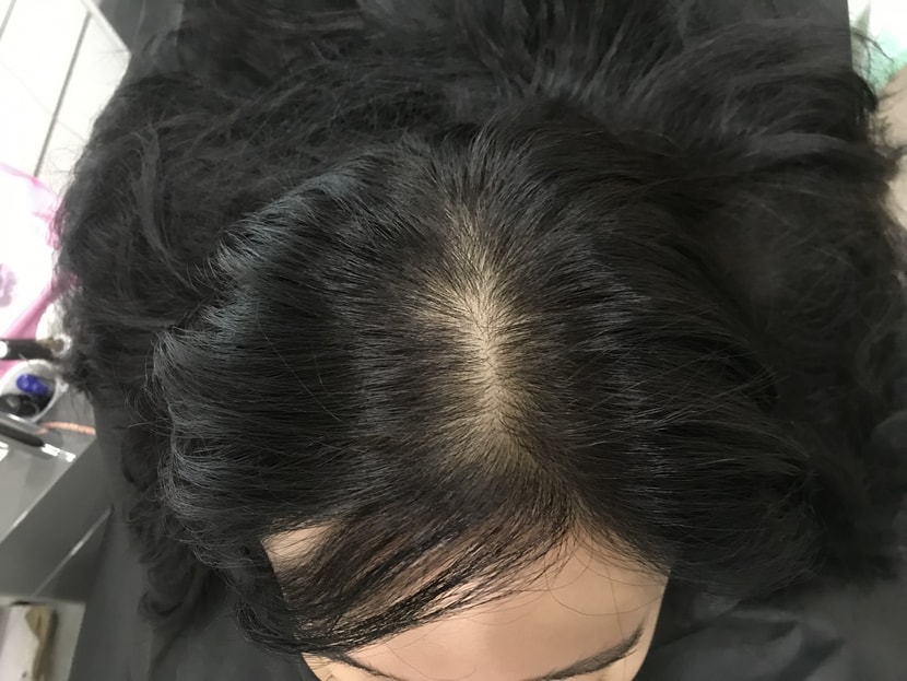 1차시술전