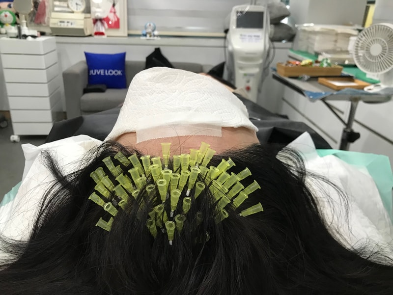 전두부 리터치 후기