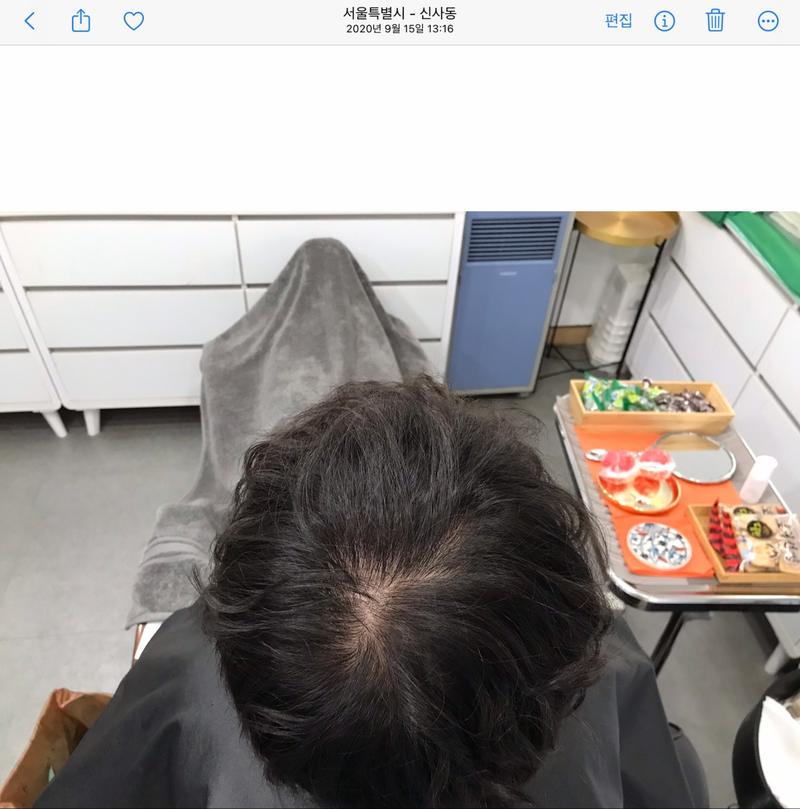 頭皮タトゥー5年後の体験談です。