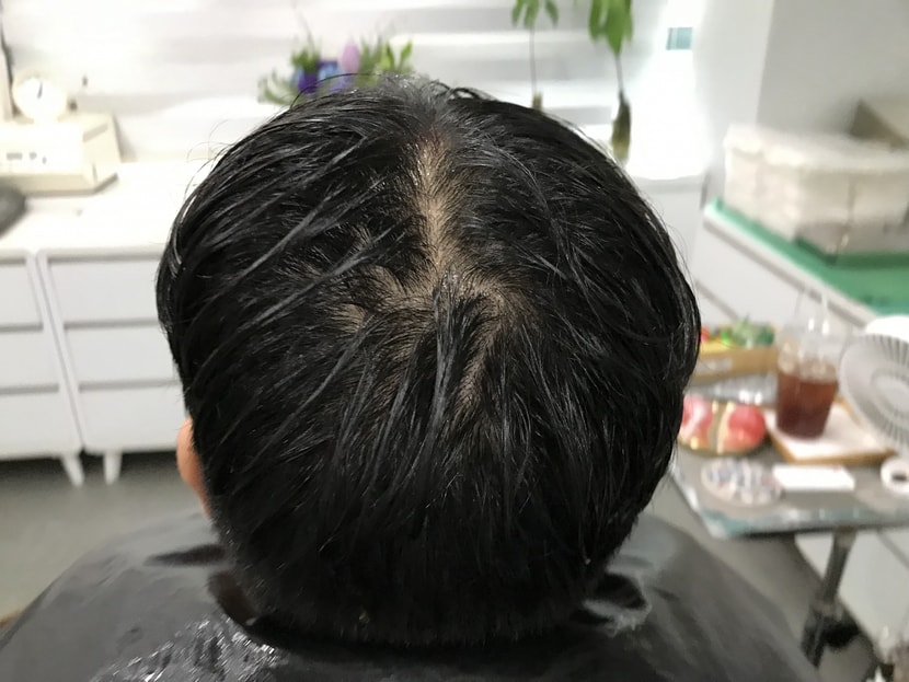 시술전