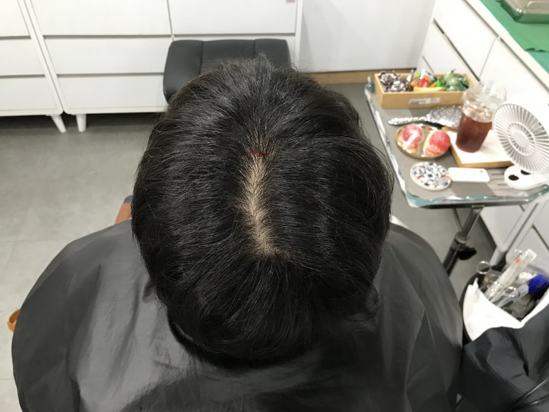 グラデーション頭皮タトゥー体験談！