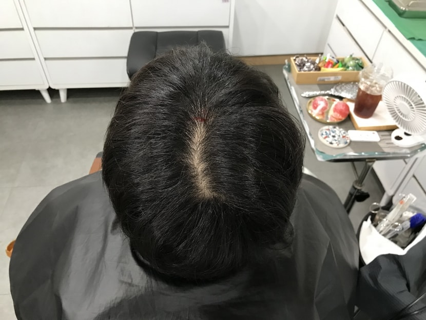 시술 전