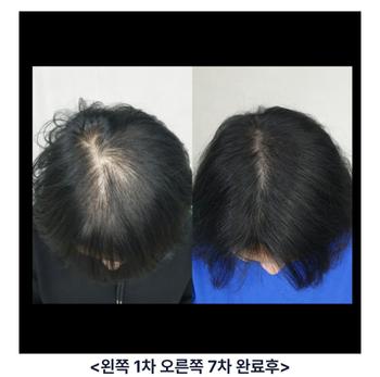 처음 두피문신 완료 후