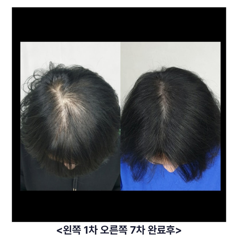 처음 두피문신 완료 후