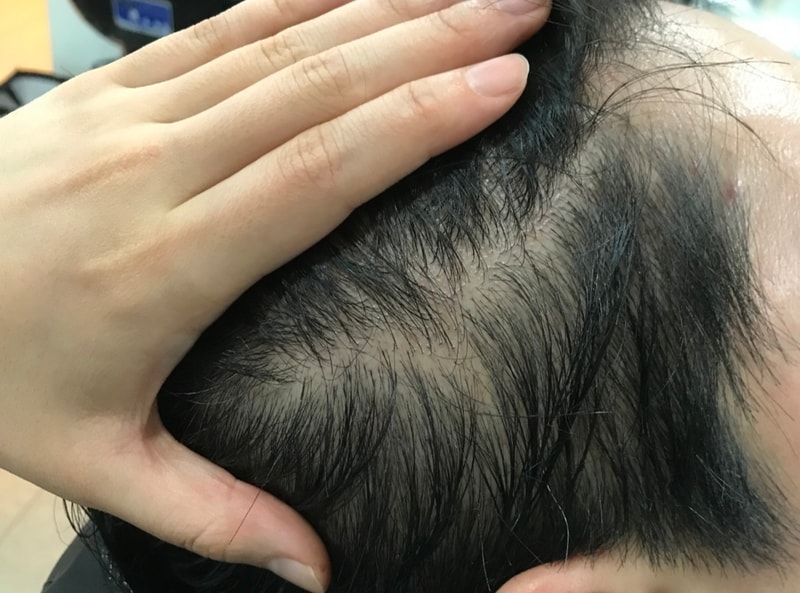 Review of scalp tattooing on the side hair
