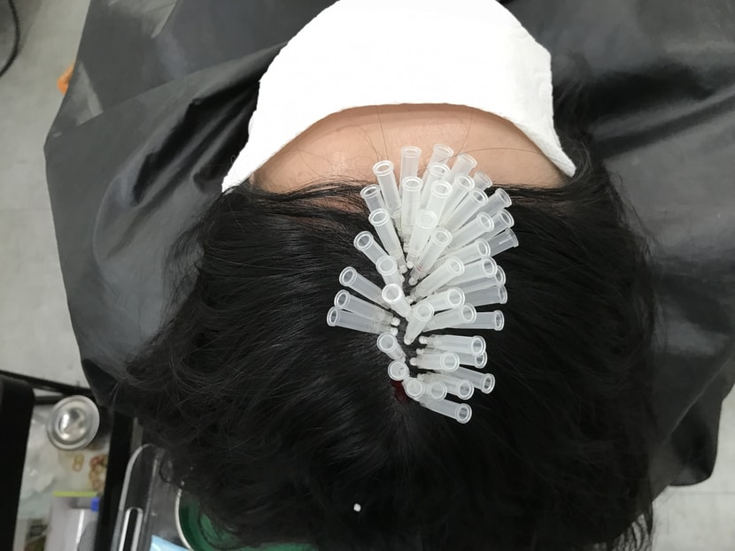 잔머리재생술
