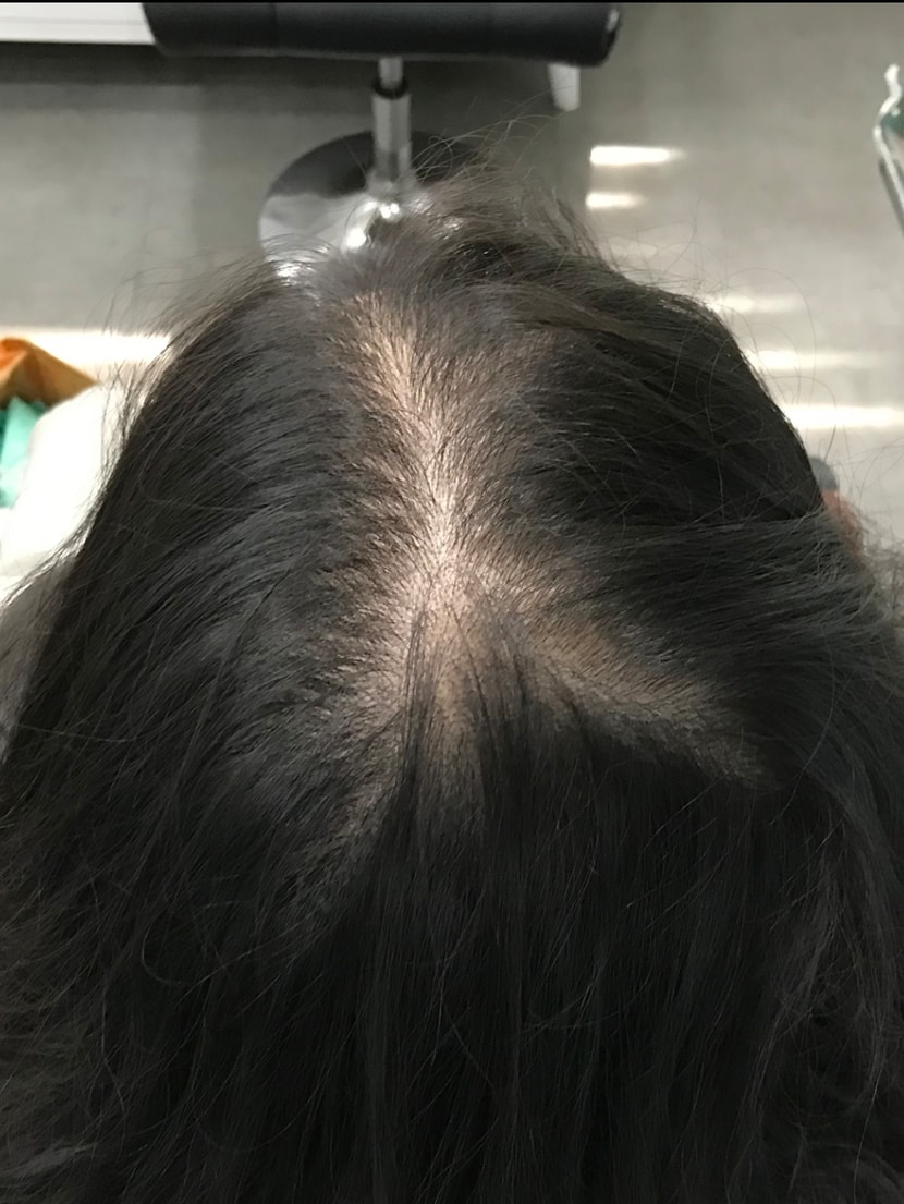시술 전