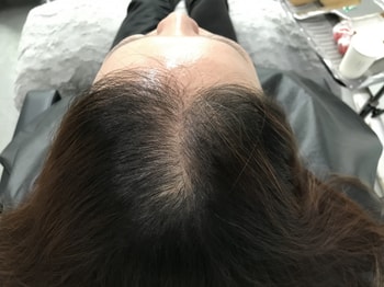 시술전
