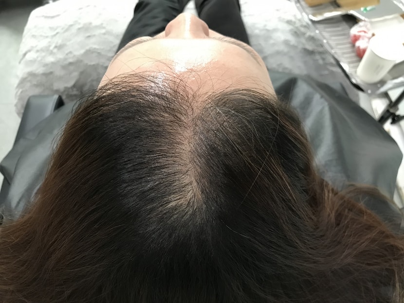 시술전