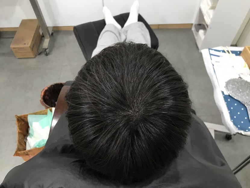 시술 후 마른 머리