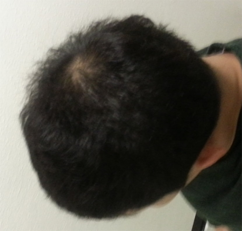 시술전 좌측(플래쉬X)