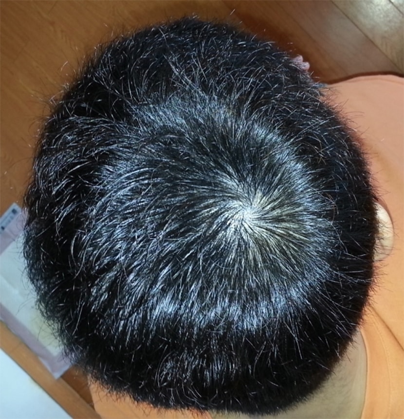 시술후6일 중앙(플래쉬 터트리고)