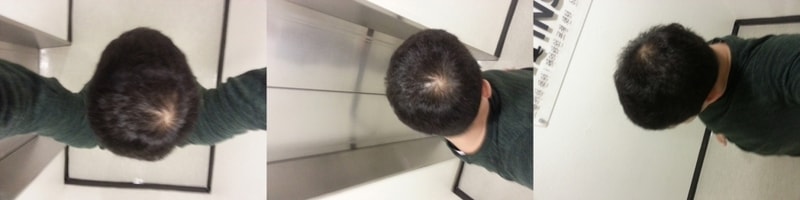 江南新发SMP(头皮纹身)后期。