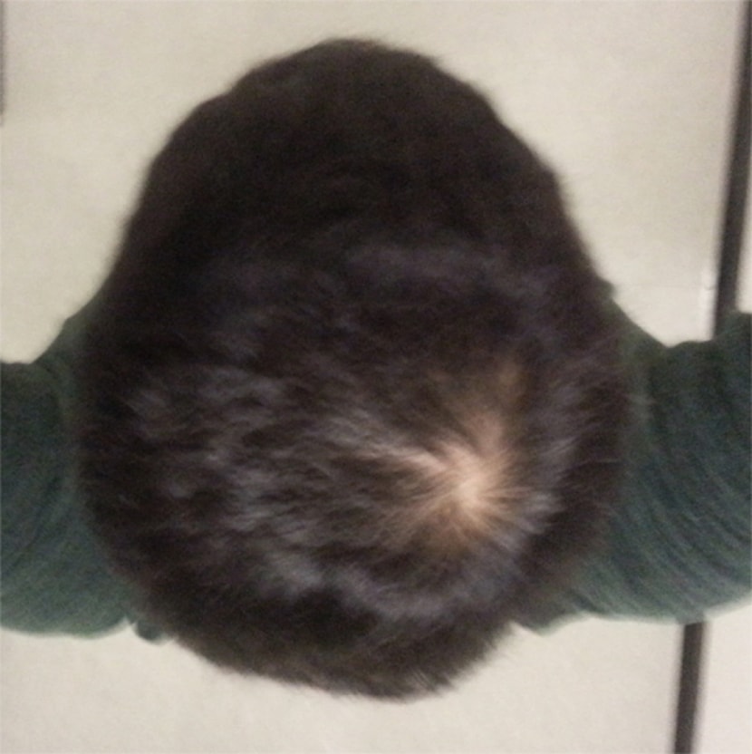 시술전 중앙(플래쉬X)