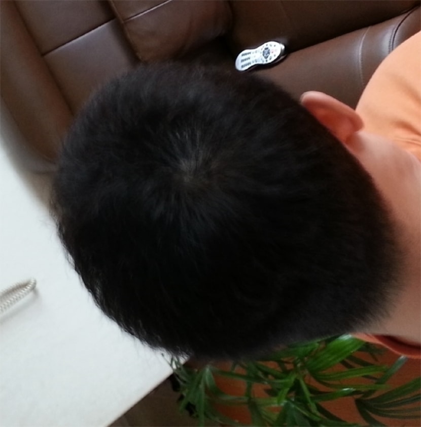 시술후6일 우측(플래쉬X)