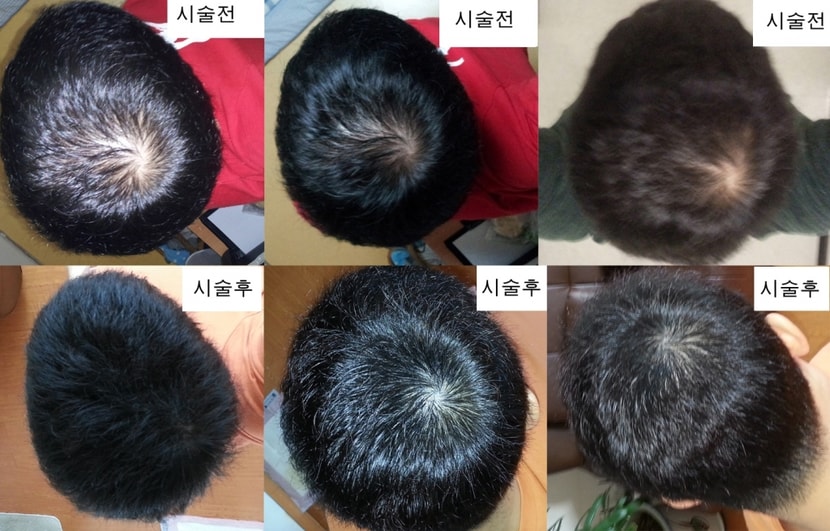 시술전후 최종 쉽게 비교