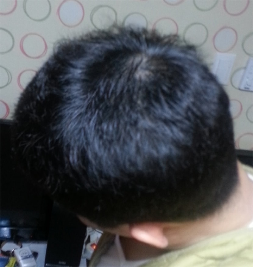 시술후6일 좌측(플래쉬X)