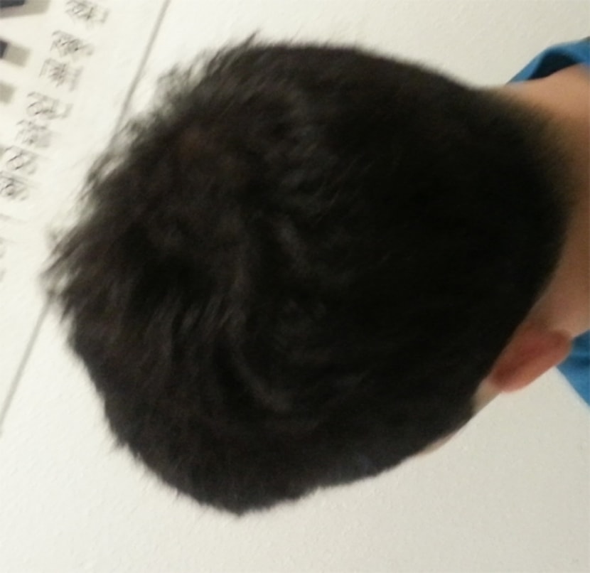 시술직후 좌측(플래쉬X)