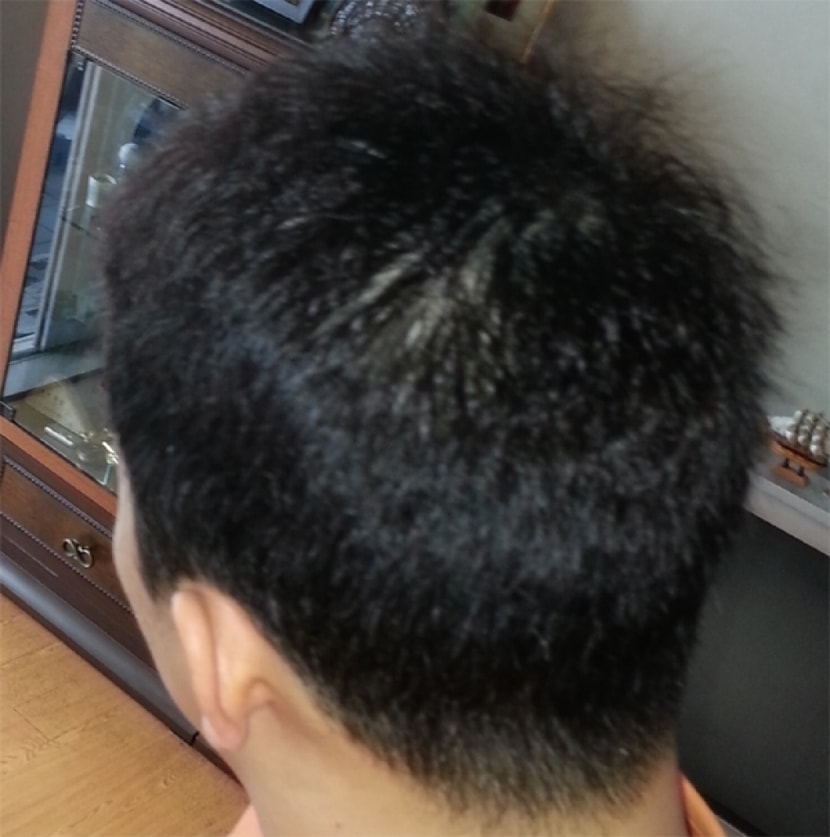 시술후6일 좌측(플래쉬 터트리고)