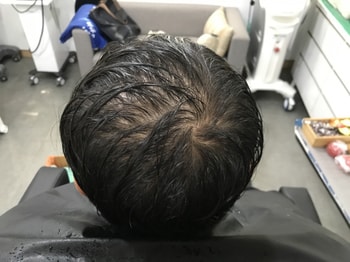 시술전