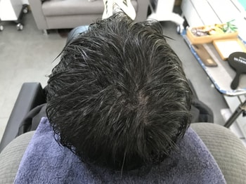 시술후