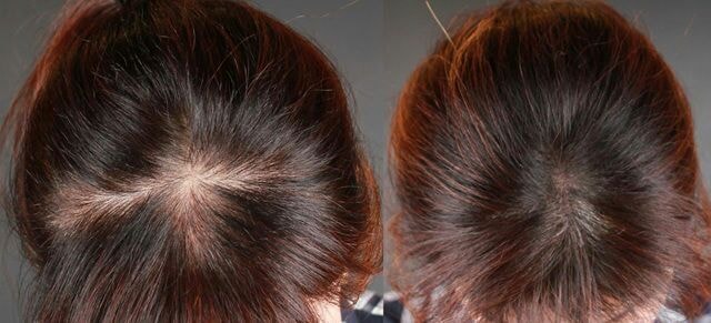 这是头皮纹身后记