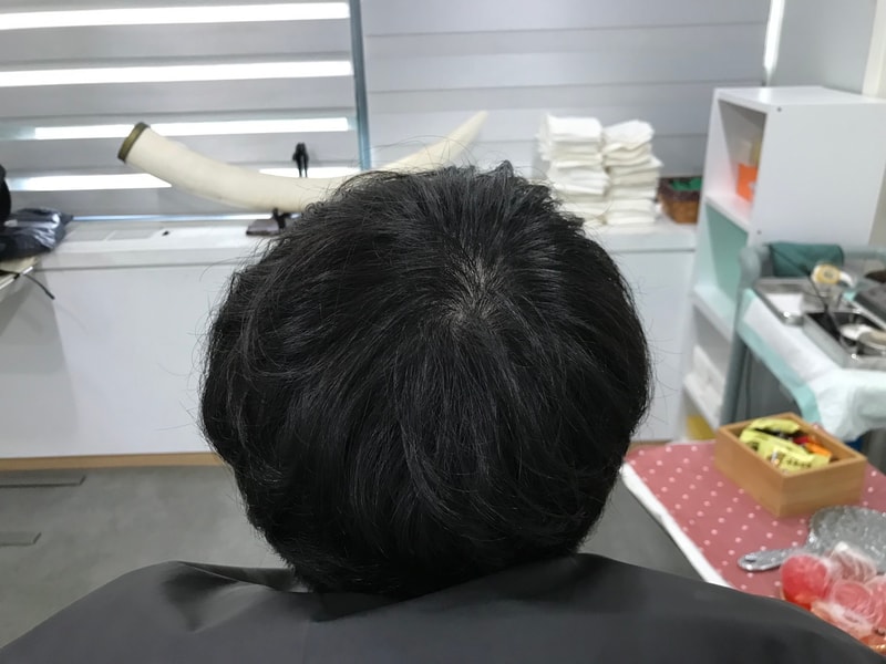 [延世美达人] 这是头皮纹身修复后记