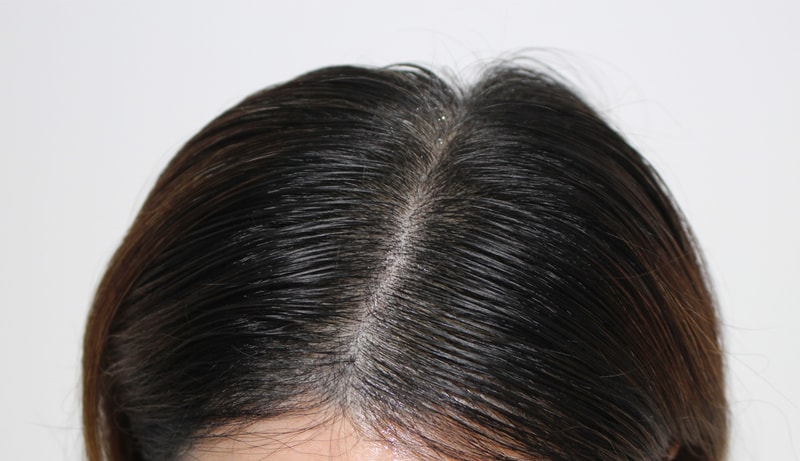 It's been a month since I got an additional scalp tattoo after the hair transplant!