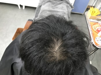 시술 전