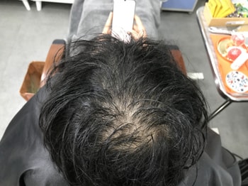 시술 전 물에 젖었을 때