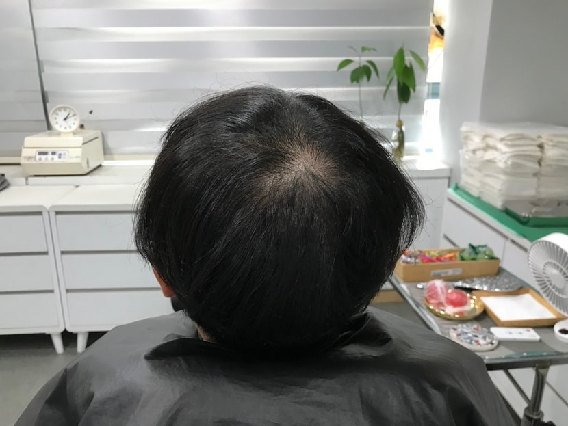 &lt;시술전_마른상태1&gt;